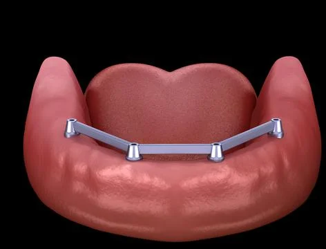 Removable Mandibular prosthesis with gum All on 4 system supported by implant Stock Illustration