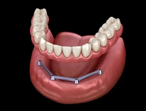 Removable Mandibular prosthesis with gum All on 4 system supported by implant Stock Illustration
