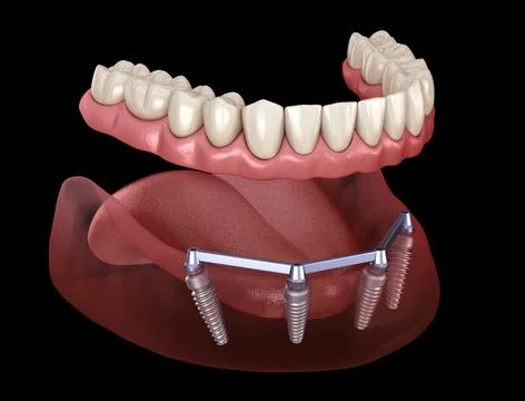 Removable Mandibular prosthesis with gum All on 4 system supported by implant Stock Illustration