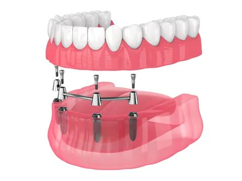 Removable overdenture installation on bar clip attachment, supported by impla Stock Illustration