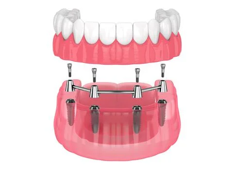 Removable overdenture installation on bar clip attachment, supported by impla Stock Illustration