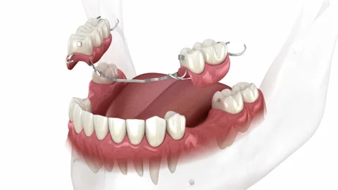 Removable partial denture, mandibular prosthesis Stock Footage 144625581