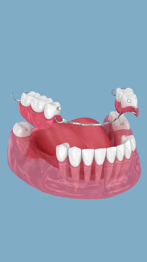 Removable partial denture, mandibular prosthesis. 3D animation Stock Footage 314537579