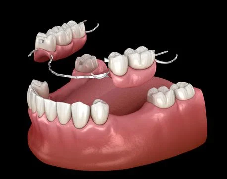 Removable partial denture, mandibular prosthesis. Medically accurate 3D Stock Illustration