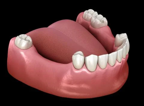 Removable partial denture, mandibular prosthesis. Medically accurate 3D Illustrazione stock