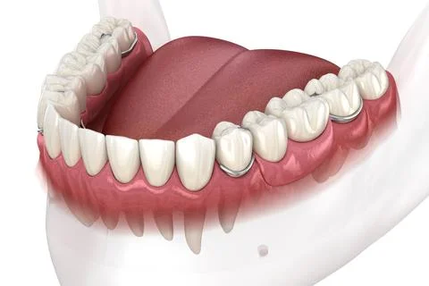 Removable partial denture, mandibular prosthesis. Illustrazione stock