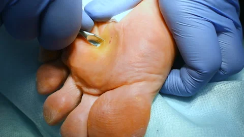 Removal of calluses or corns on the leg surgically close-up Stock Footage 100471634
