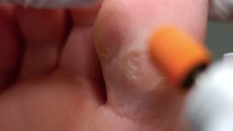 Removal of calluses from the patient's big toe in the salon using grinding tool Stock Footage 239655112