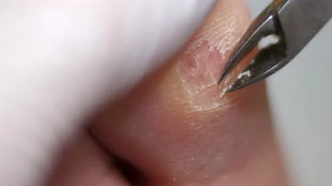 Removal of calluses from the sole of the foot with forceps. podology Stock Footage 239640023
