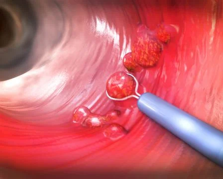 Removal of a colonic polyp with a electrical wire loop during a colonoscopy Stock Illustration