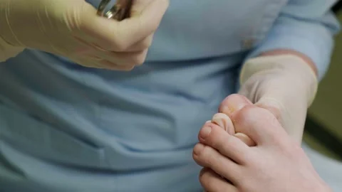 Removal of the keratinized layer of skin from the nail with forceps. Health Stock-Footage 239655417