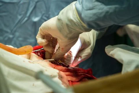 Removal of a malignant tumor Stock Photos