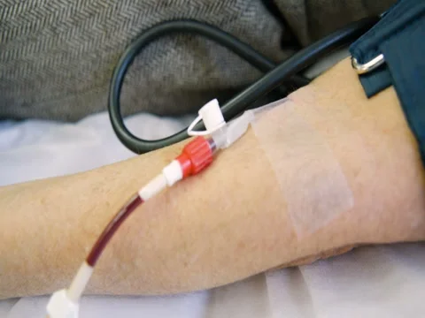 Removal of plasma from the blood Stock Footage 82615925