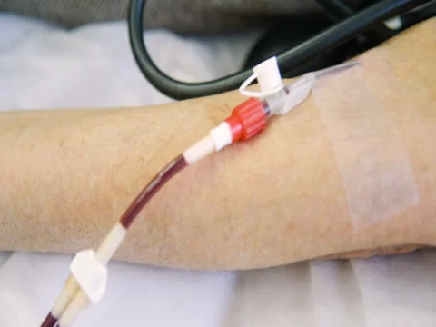 Removal of plasma from the blood Stock Footage 82615936