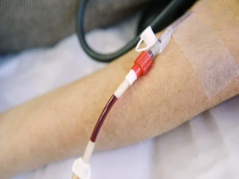 Removal of plasma from the blood Stock-Footage 82615944