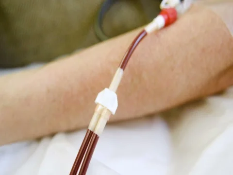 Removal of plasma from the blood Stock Footage 82615958