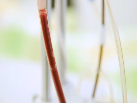 Removal of plasma from the blood Stock Footage 82615969