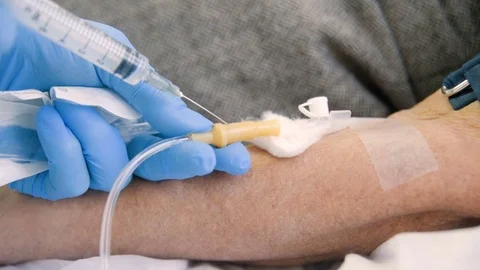 Removal of plasma from the blood without removing the blood elements Stock Footage 82615746