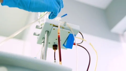 Removal of plasma from the blood without removing the blood elements Stock Footage 82615839