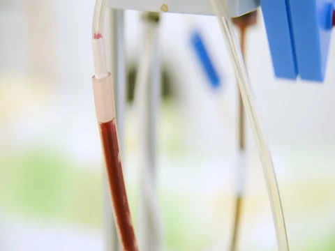 Removal of plasma from the blood without removing the blood elements Stock Footage 82615977