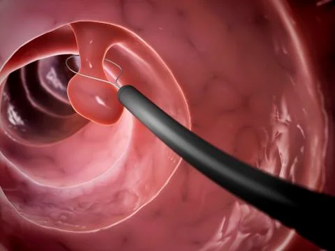 Removal of polyp, artwork Stock Illustration