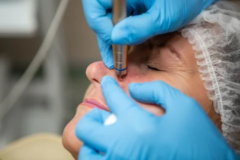 Removal of red spots, rosacea, blood vessels, on the face of a Caucasian woman Stock Photos