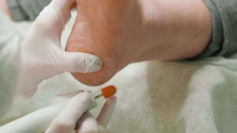 Removal of the rough keratinized layer from the heel skin using grinding tool Stock-Footage 239640236