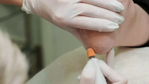 Removal of the rough layer from the heel skin using the grinding tool. Podology Video stock 239640113