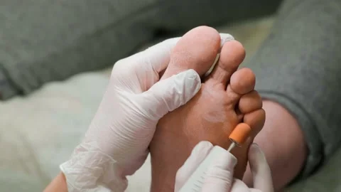 Removal of a rough layer from the skin of the foot using the grinding tool 스톡 동영상 239640249