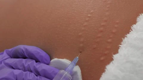 Removal stretch mark Stock Footage 282262346