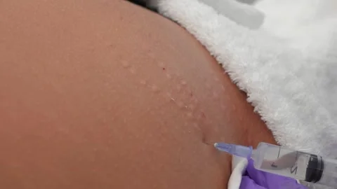 Removal stretch mark Stock Footage 285897012