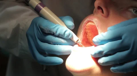 Removal of tartar 스톡 동영상 42799369