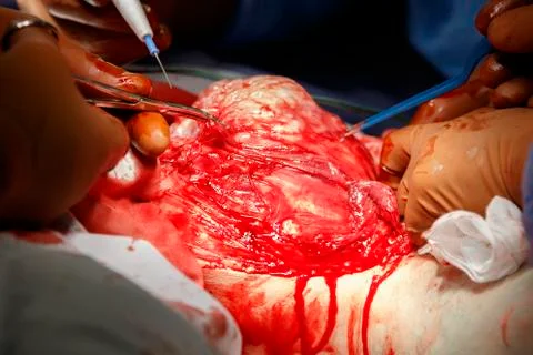Removal of the tumor Photos