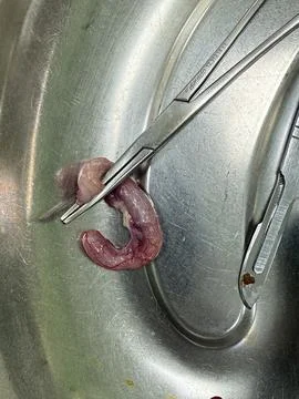 Removed Appendix Specimen with Surgical Instruments in a Metal Dish Stock Photos