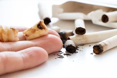 Removed decayed teeth with caries lie on a woman's hand next to cigarette but Stock Photos