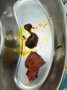 Removed Gallbladder and Two Dark Gallstones in a Kidney Dish Stock Photos