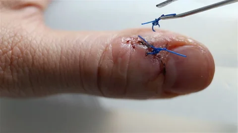 Removed surgical suture extremely close-up. Real time, natural light, contains p Stock Footage 143749680
