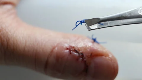 Removed the surgical suture on the forceps. Extreme close-up, real time, natural Stock Footage 143749656