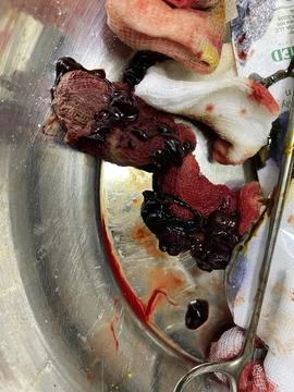 Removed Thrombus from Hemorrhoids 2 Stock Photos