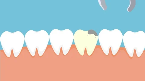Removing a dead tooth and replacing it w... | Stock Video | Pond5