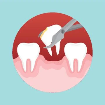 Removing Decayed Tooth Stock Illustration