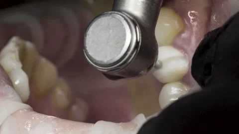 Removing The Defective Structure Of A To... | Stock Video | Pond5