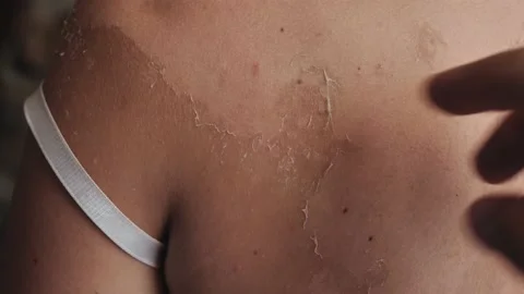 Removing peeling skin from a sunburn. Remove peeling skin after sunburn Stock Footage 134636947