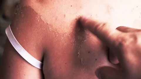 Removing peeling skin from a sunburn. Remove peeling skin after sunburn Stock Footage 146906916