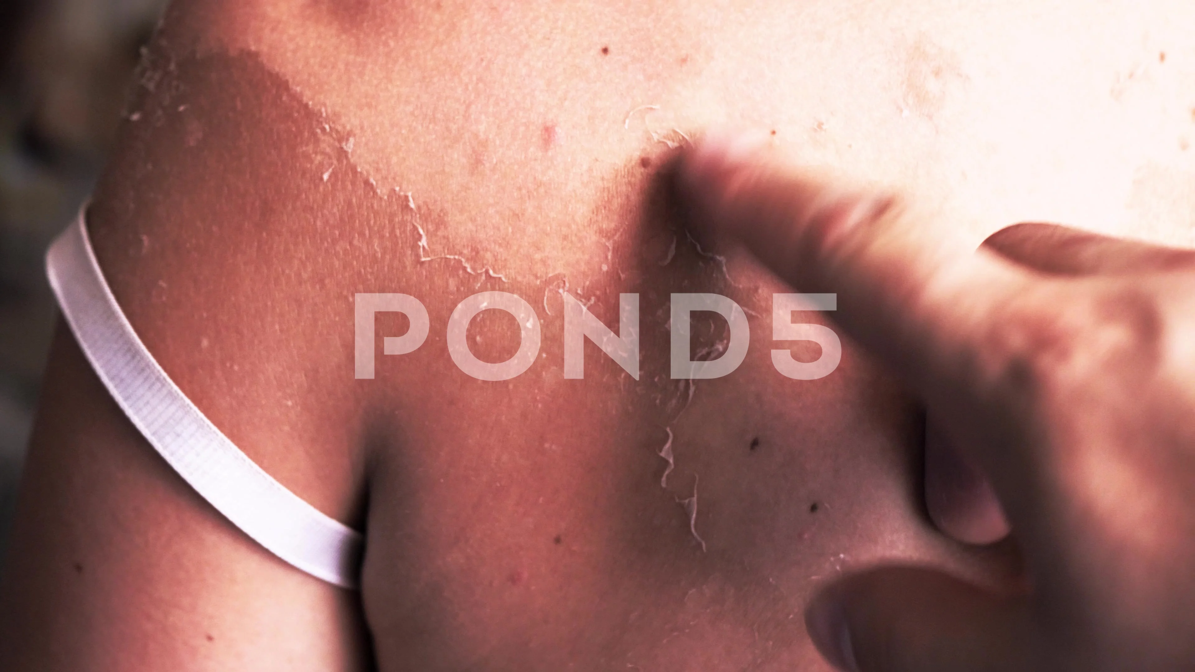 Removing Peeling Skin From A Sunburn Re Stock Video Pond5