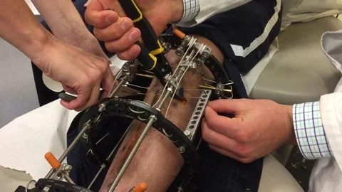 Removing Pins from an External Fixator Stock-Footage 74924138