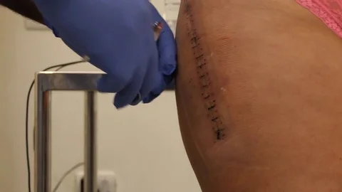 Removing stitches from wound after hip surgery Stock Footage 83809200