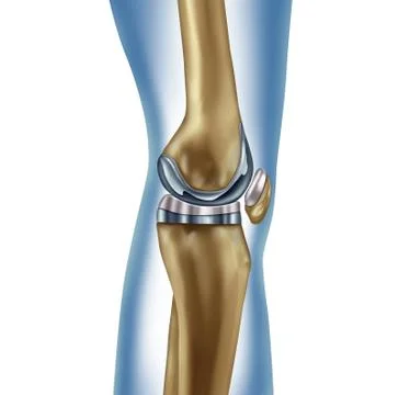 Replacement Knee 스톡 일러스트