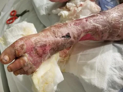 Resolving streptococcal cellulitis with desquamation of skin Stock Photos