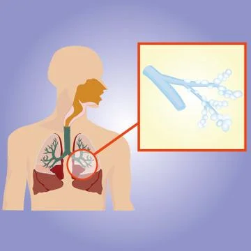 Respiratory system. Bronchi increased Stock Illustration